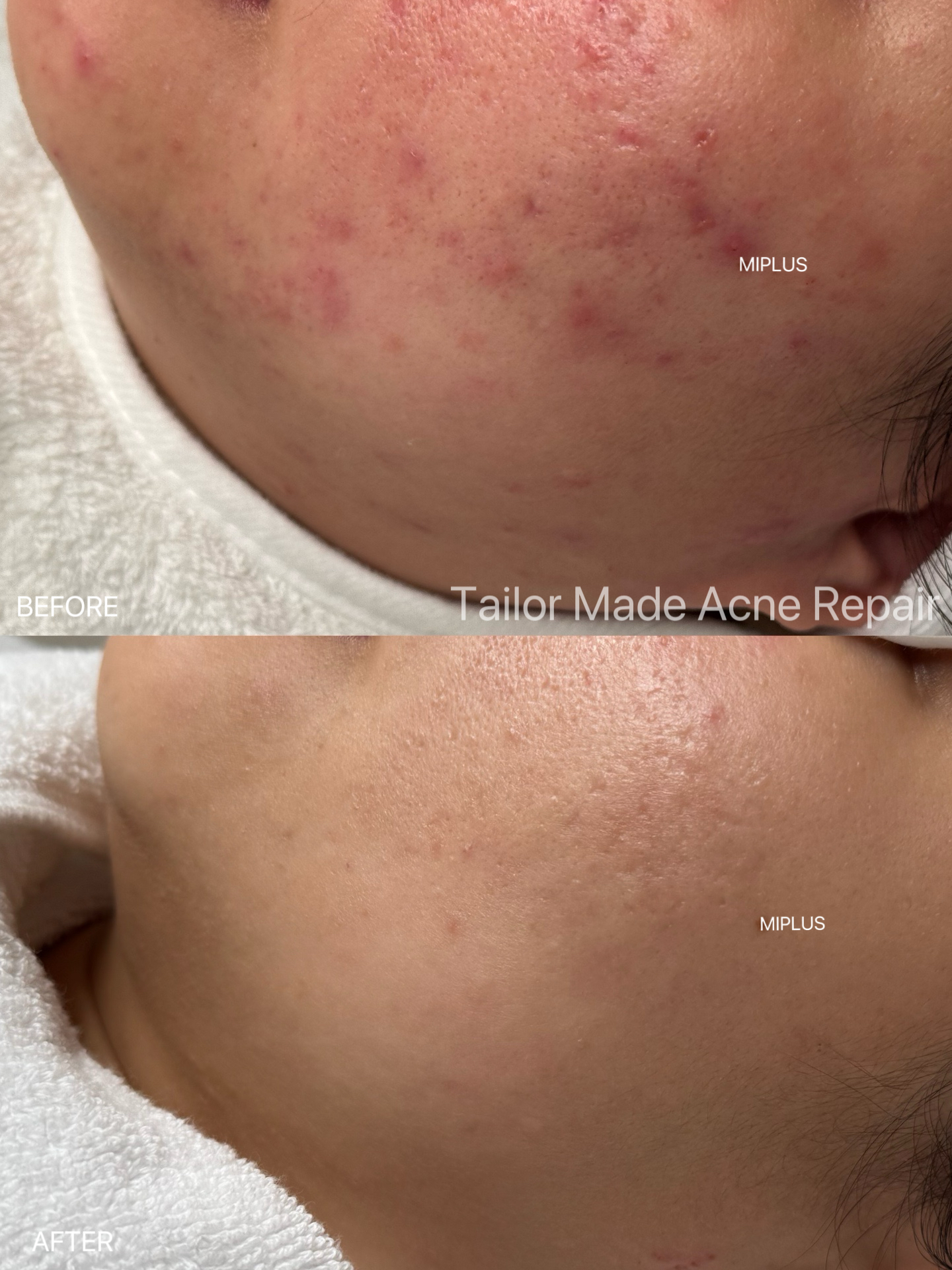 Acne Transformation Detail